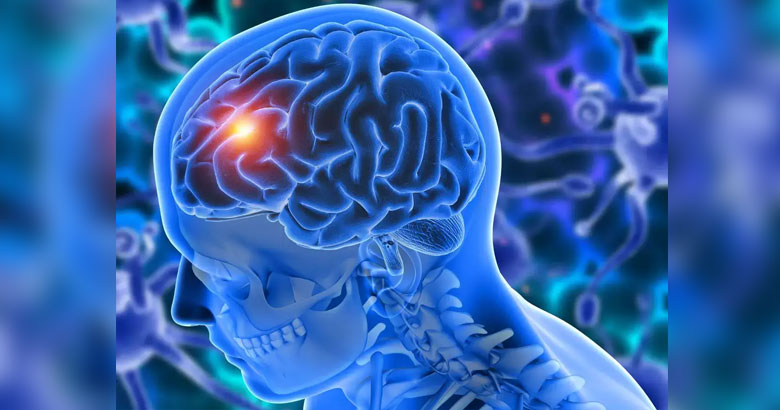 brain tumor