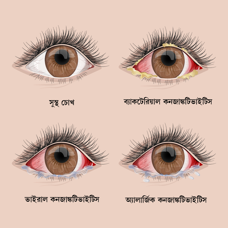 Conjunctivitis types Bangla shutterstock 1030346716